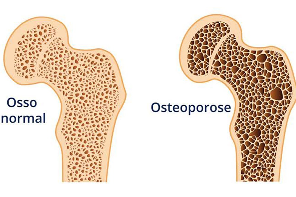 Doenças dos Ossos