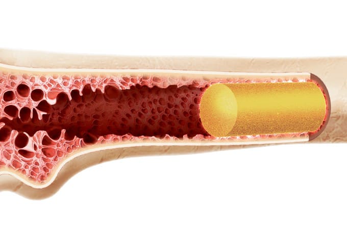 A MEDULA, O SANGUE E A LEUCEMIA