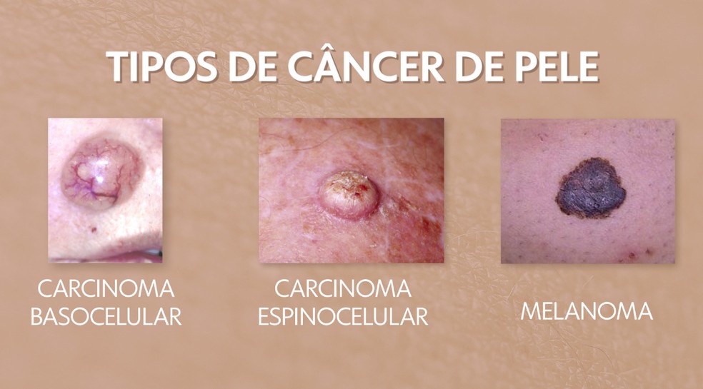 Tipos de câncer de pele melanoma