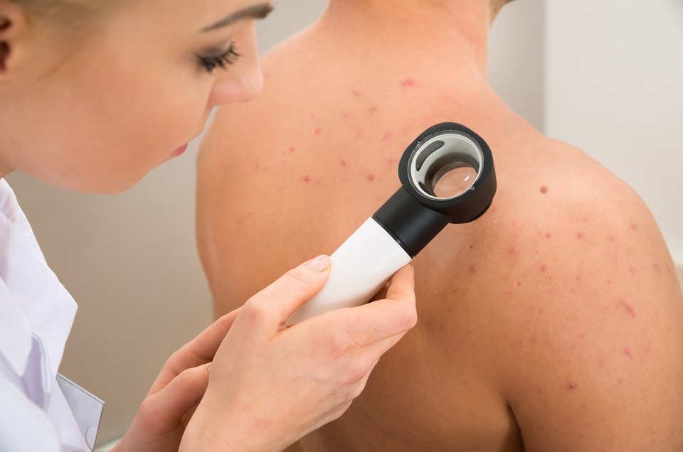 Sintomas e sinais do câncer de pele melanoma